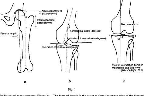 Figure 1 From Varus Derotation Osteotomy For Persistent Dysplasia In