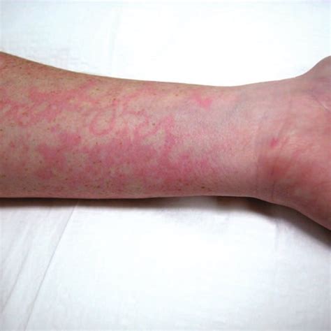 Erythema Marginatum On The Arm Of A Patient With Hereditary Angioedema