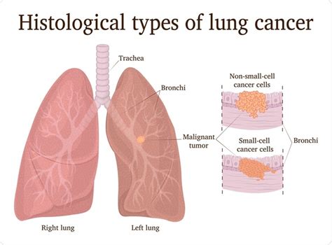 What Are The Differences Between Small Cell And Non Small Cell Lung Cancer