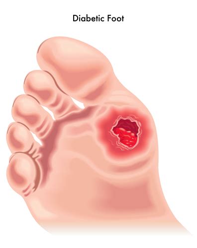 diabetic foot complications santa monica podiatry