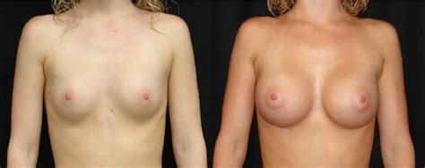 Age 22 Female Breast Augmentation Dr Alspaugh
