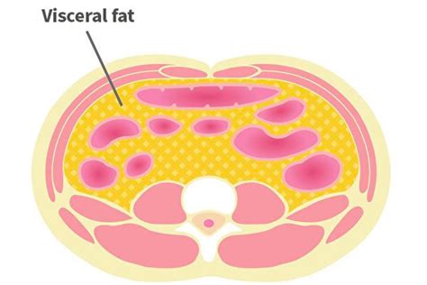 Visceral Fat May Lead To 6 Diseases Including Dementia And Cancer 2