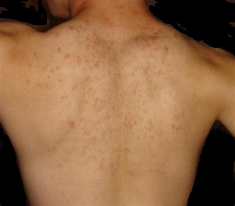 Back Acne Scars Pic Scar Treatments Community