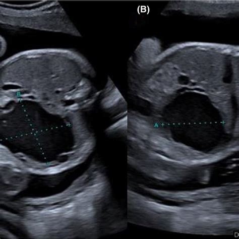 Pdf Prenatal Diagnosis And Management Of A Giant Intrahepatic
