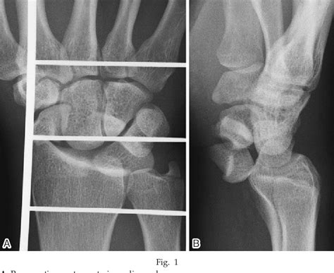 Figure From Trans Scaphoid Perilunate Fracture Dislocation With Concomitant Lunotriquetral