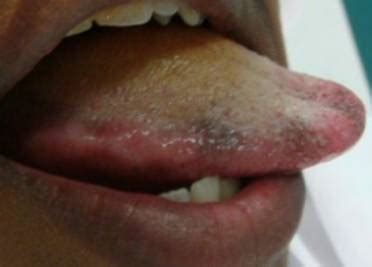 Black Bumps On Tongue Causes And Treatment Iytmed Com My Xxx Hot Girl