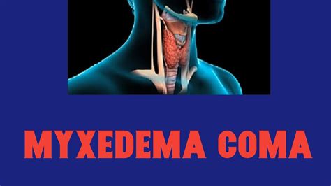 Myxedema Coma Hypothyroidism Youtube