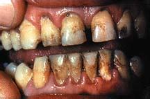 Oral cancer most commonly involves the lips or the tongue. Snus News & Other Tobacco Products: 8/5/07 - 8/12/07