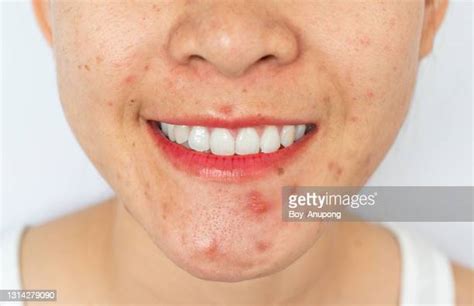 Old Age Spots On Skin Photos And Premium High Res Pictures Getty Images