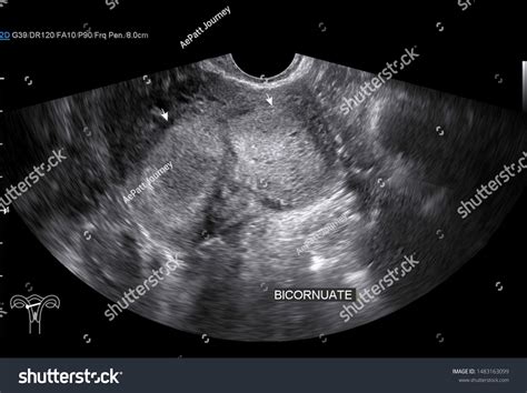 Transvaginal Ultrasound Uterus Bicornuate Uterus Transverse Stock Photo
