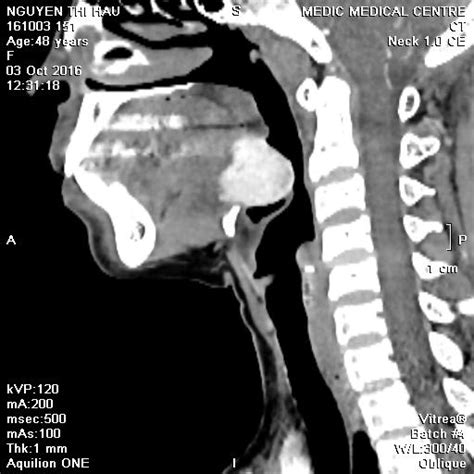 Vietnamese Medic Ultrasound Case Ectopic Thyroid Gland Dr Phan