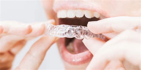 7 Myth And Facts About Clear Aligners Or Invisible Braces