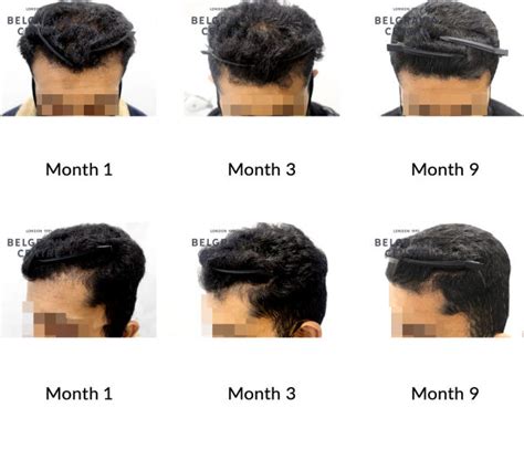 Hair Growth Success Story I Definitely See A Lot Of Change