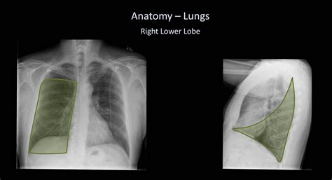 Chest X Ray For Students How To Interpret And Present Methodically
