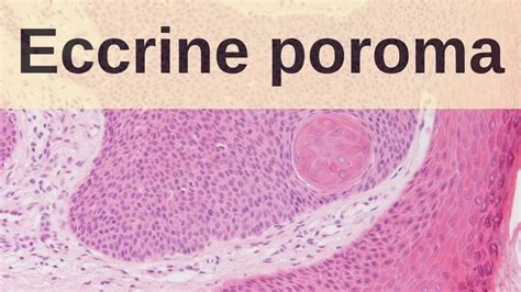 Eccrine Poroma Pathology Mini Tutorial Youtube