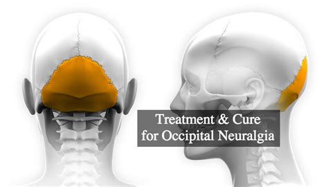 Occipital Neuralgia Treatment