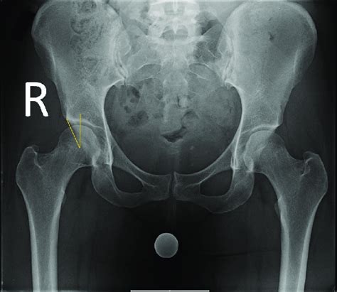 Anteroposterior Pelvis Preoperative X Ray Right Side R Shows True