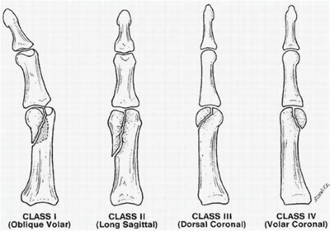Pip Joint Anatomy