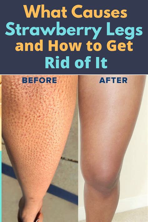 What Causes Strawberry Legs And How To Get Rid Of It Strawberry Legs
