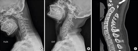 What Causes Severe Myelopathy Resulting In Acute Quadriplegia After A