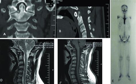 A Coronal Computed Tomography Scan Of Cervical Spine Showing The
