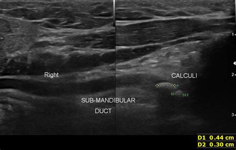 Submandibular Duct Calculi Shivi X Ray And Ultrasound Centre Shivi