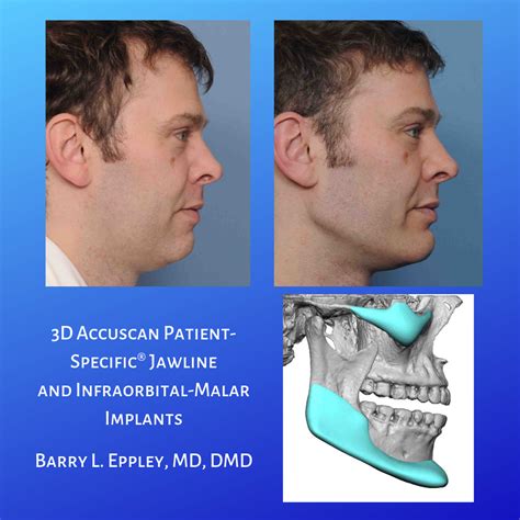 Wow Check Out The Amazing Results Dr Eppley Achieved With 3d