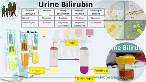 Urine Bilirubin Normal Range Test Results And Clinical Significance A Comprehensive Guide
