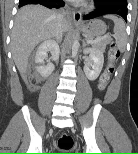 Renal Laceration With Contrast Extravasation From The Renal Pelvis On