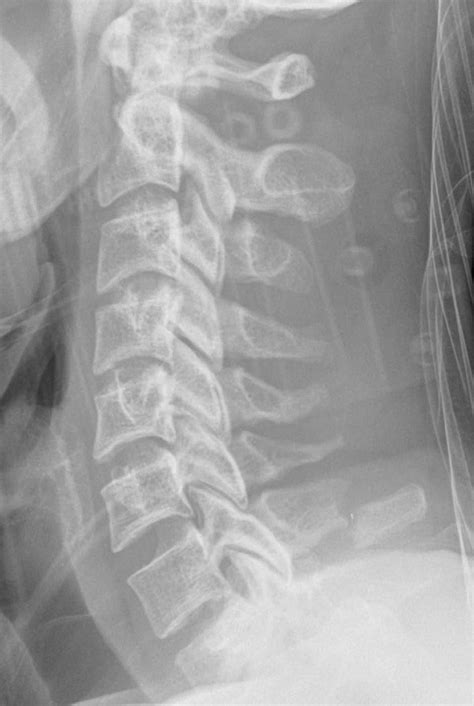 Cervical Spine Injuries Part Ii 2012 07 02 Ahc Media Continuing