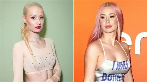 Inside Iggy Azalea S Plastic Surgery Transformation