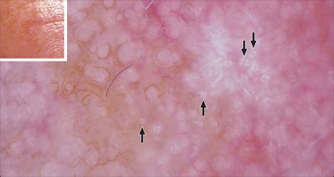 New Dermoscopic Pattern In Actinic Keratosis And Related Conditions