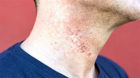 39 Awesome Rash On Neck After Haircut Haircut Trends