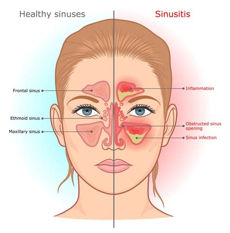Sinus Infection Warning Signs And Symptoms When To See A Doctor For