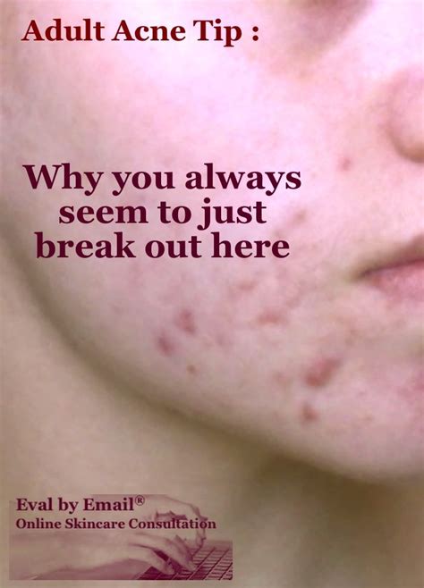 Pin On Adult Acne Solutions