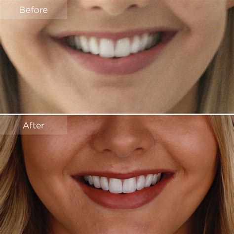 How Much Does Invisalign Cost In Australia The Dental Room
