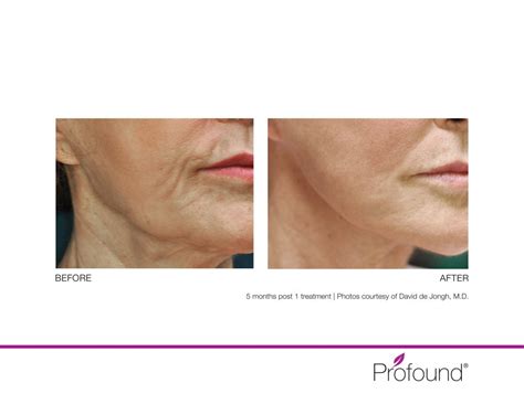 Profound Before And After 1 Skin Medispa