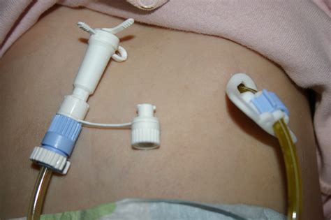Die Peg Sonde Bei Frühgeborenen Ein Weg Zur Optimalen Ernährung Und