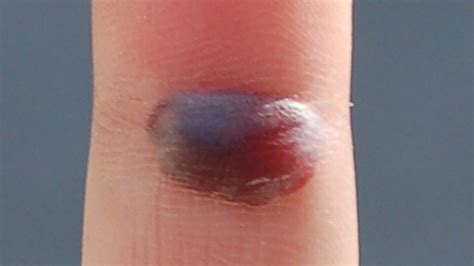What Does A Blood Blister Look Like Wholesale Cheapest Save 41