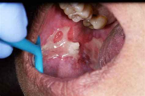 Mouth Ulcer Causes Symptoms Treatment Cure Museum Dental Center