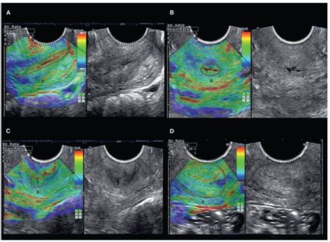Imaging Of The Uterine Cervix Radiology Key