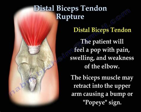 Distal Biceps Tendon Rupture Everything You Need To Know Dr Nabil