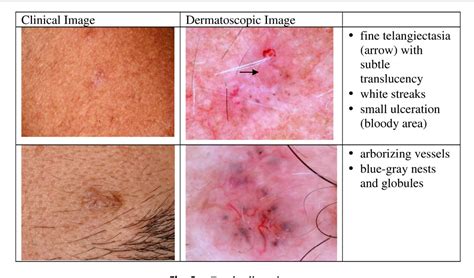 Figure 3 From Dermatoscopy An Overview Of Subsurface Morphology