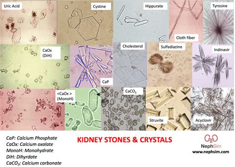 Uric Acid Crystals In Urine Under Microscope Micropedia