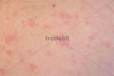 Allergic Skin Reaction Caused By An Intolerance To Penicillin Dow