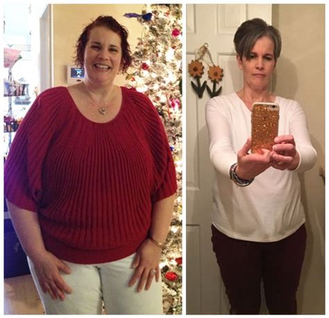 Gastric Sleeve Surgery Before And After Pictures Gastric Sleeve Before And After Stories Jet