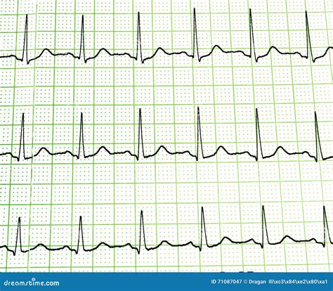 Prueba Del Electrocardiograma Imagen De Archivo Imagen De Diagrama