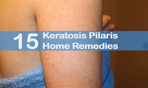 15 Diy Home Remedies For Keratosis Pilaris — Info You Should Know