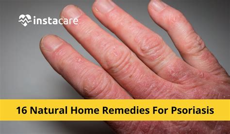 16 Natural Home Remedies For Psoriasis