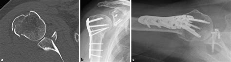 8 Type 2 Glenohumeral Combination Fracture In A 59 Year Old Female